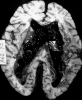 Hypertensive hemorrhage with rupture into the ventricular system